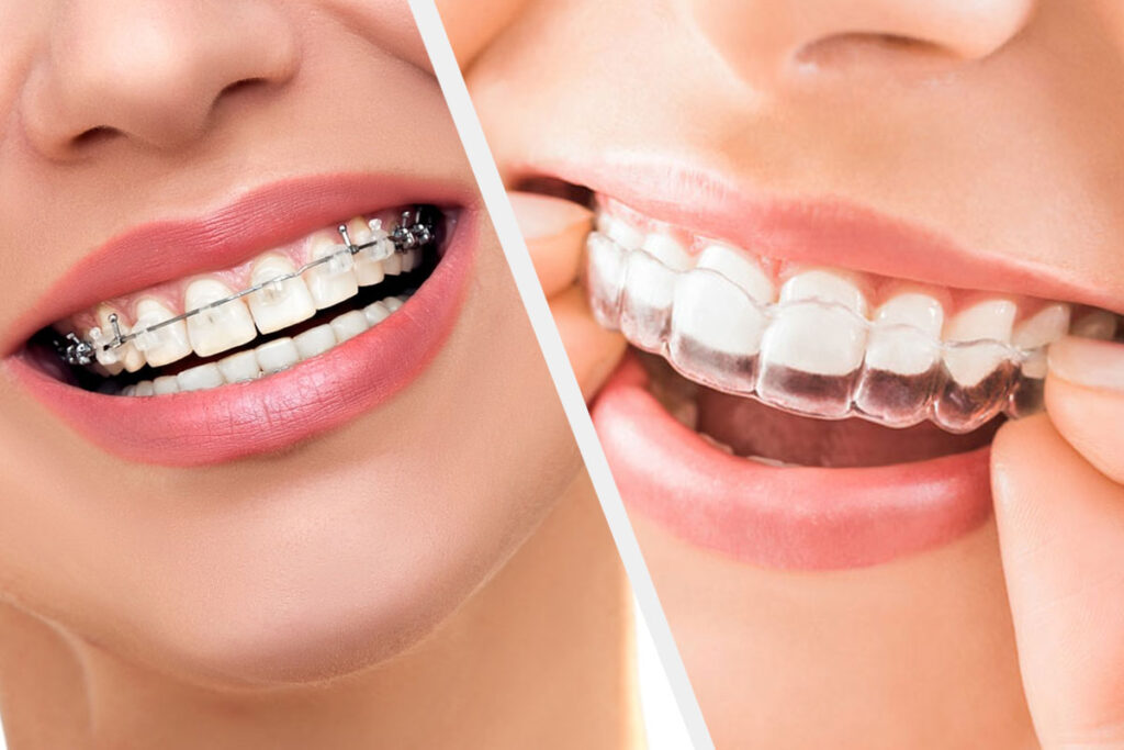 transparent braces invisible aligners